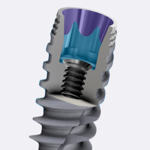 Cross section of an active hex implant